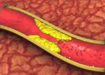 پیشگیری از تصلب شرایین پیشگیری از تصلب شرایین